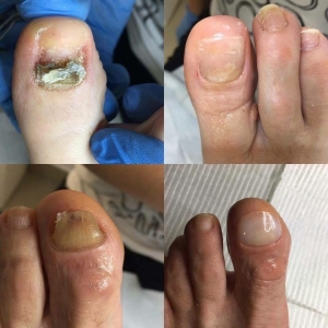 Darmowe zabiegi rekonstrukcji paznokcia u stopy