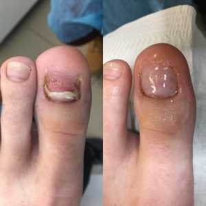 Darmowy zabieg odbudowy paznokci u stóp