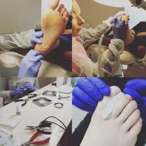 Darmowe zabiegi odbudowy płytki paznokciowej stopy