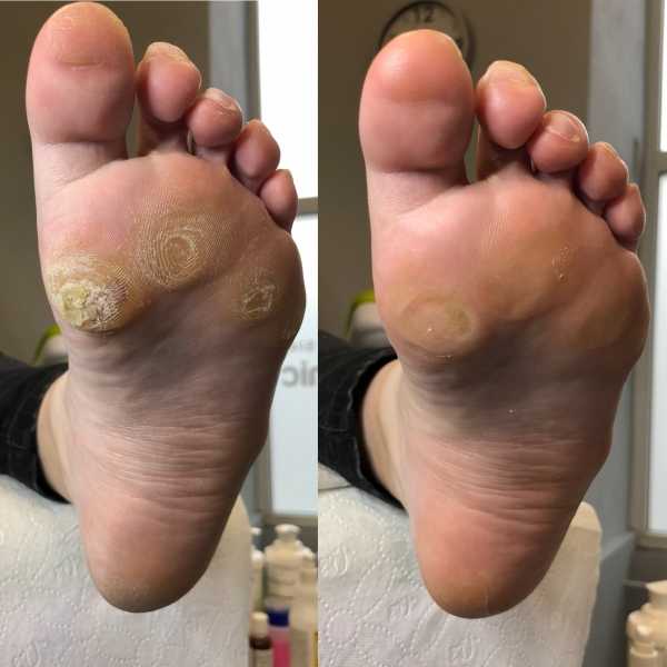 Darmowe usuwanie odcisków i twardej skóry na stopach