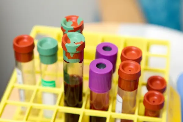 Wpływ żelaza na erytrocyty – dlaczego jego poziom jest tak ważny? Wpływ żelaza na erytrocyty – dlaczego jego poziom jest tak ważny?