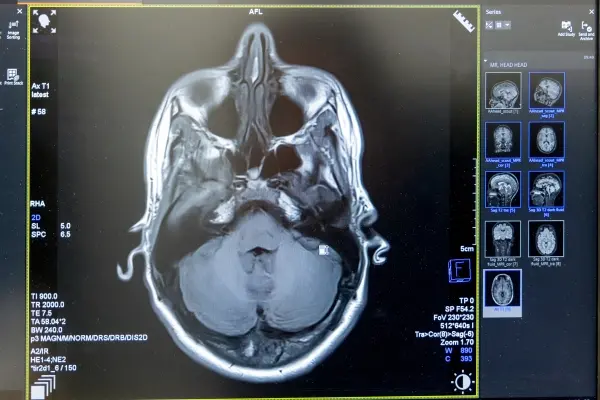 Warszawski rezonans magnetyczny głowy pozwala zdiagnozować wiele różnych dolegliwości